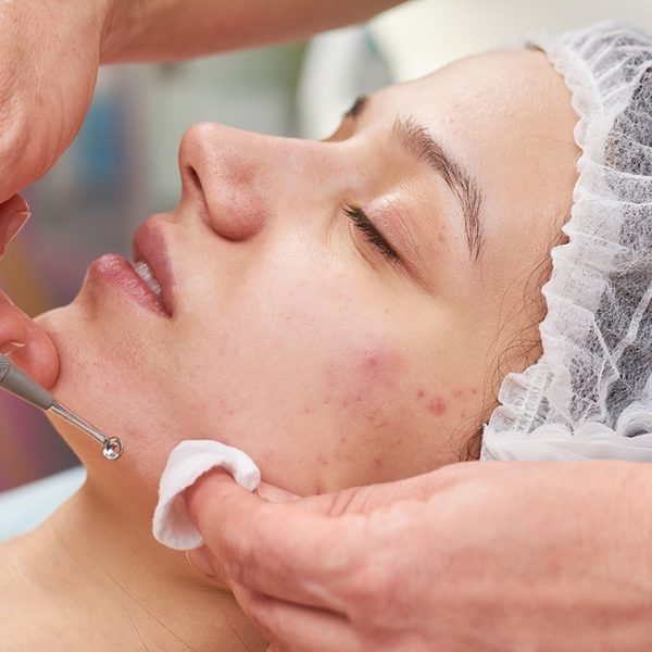 Acne Scar Treatment
