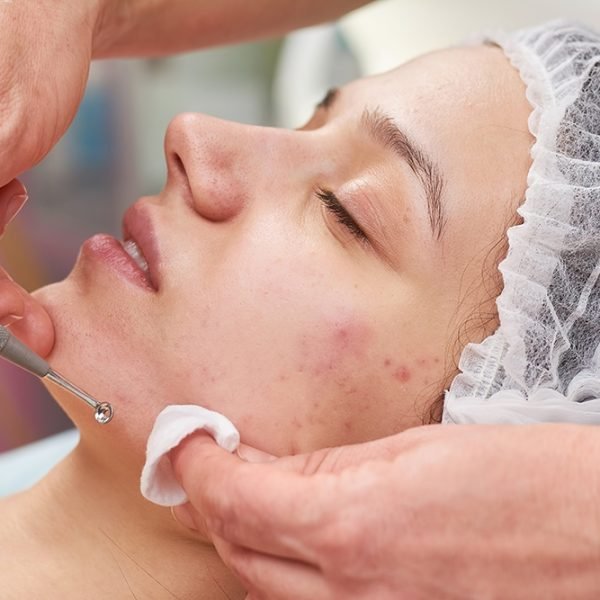 Acne Scar Treatment